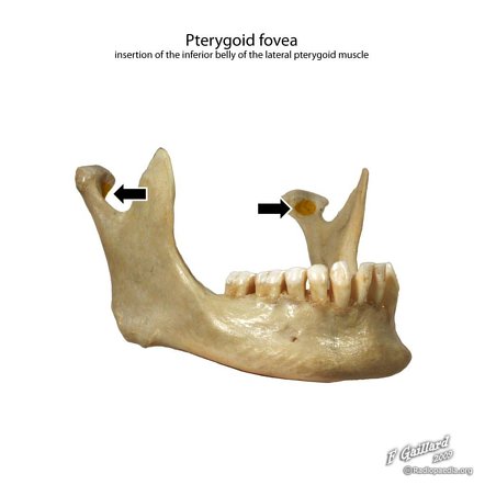 Pterygoid Fovea | Radiology Reference Article | Radiopaedia.org