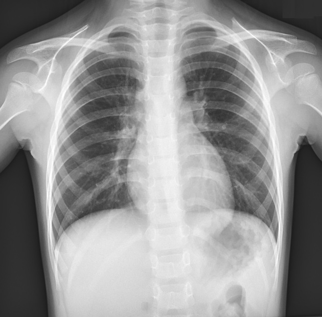 Normal Infant Chest Xray