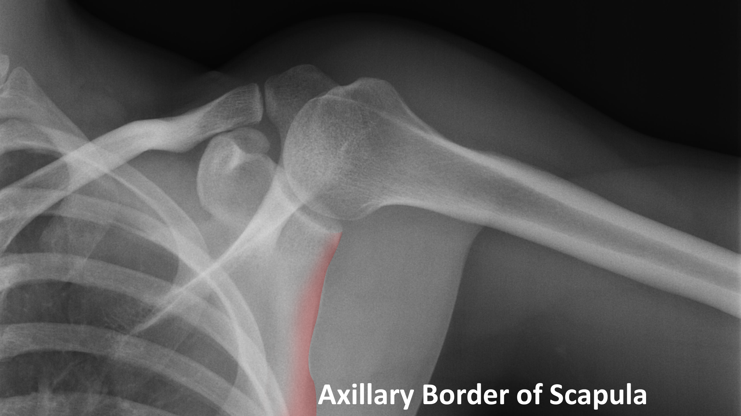 Normal radiographic anatomy of the shoulder Image