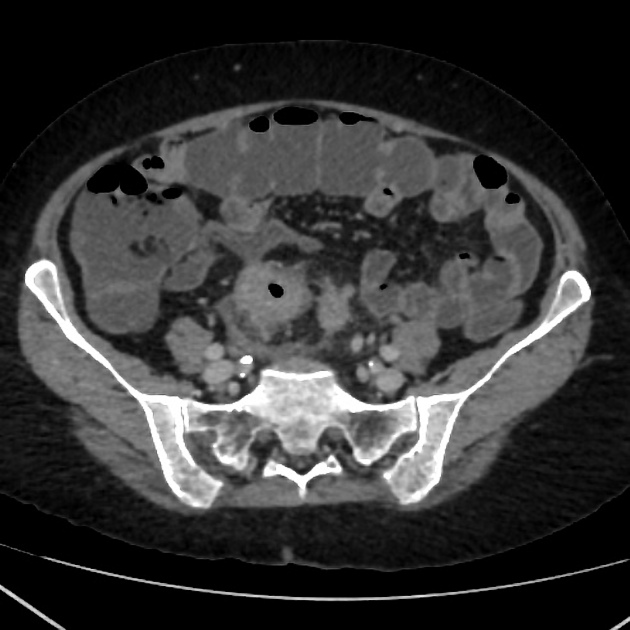 Colon Cancer Ct Uspstf Approves Ct Colonoscopy For