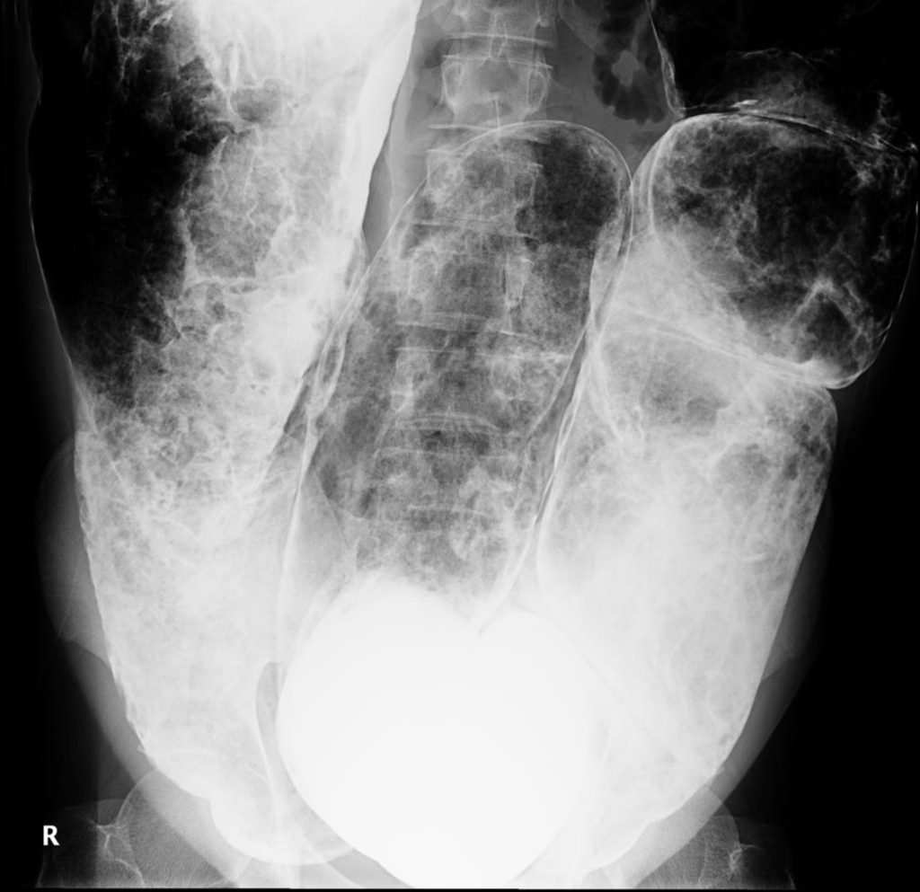 Ogilvie syndrome Image