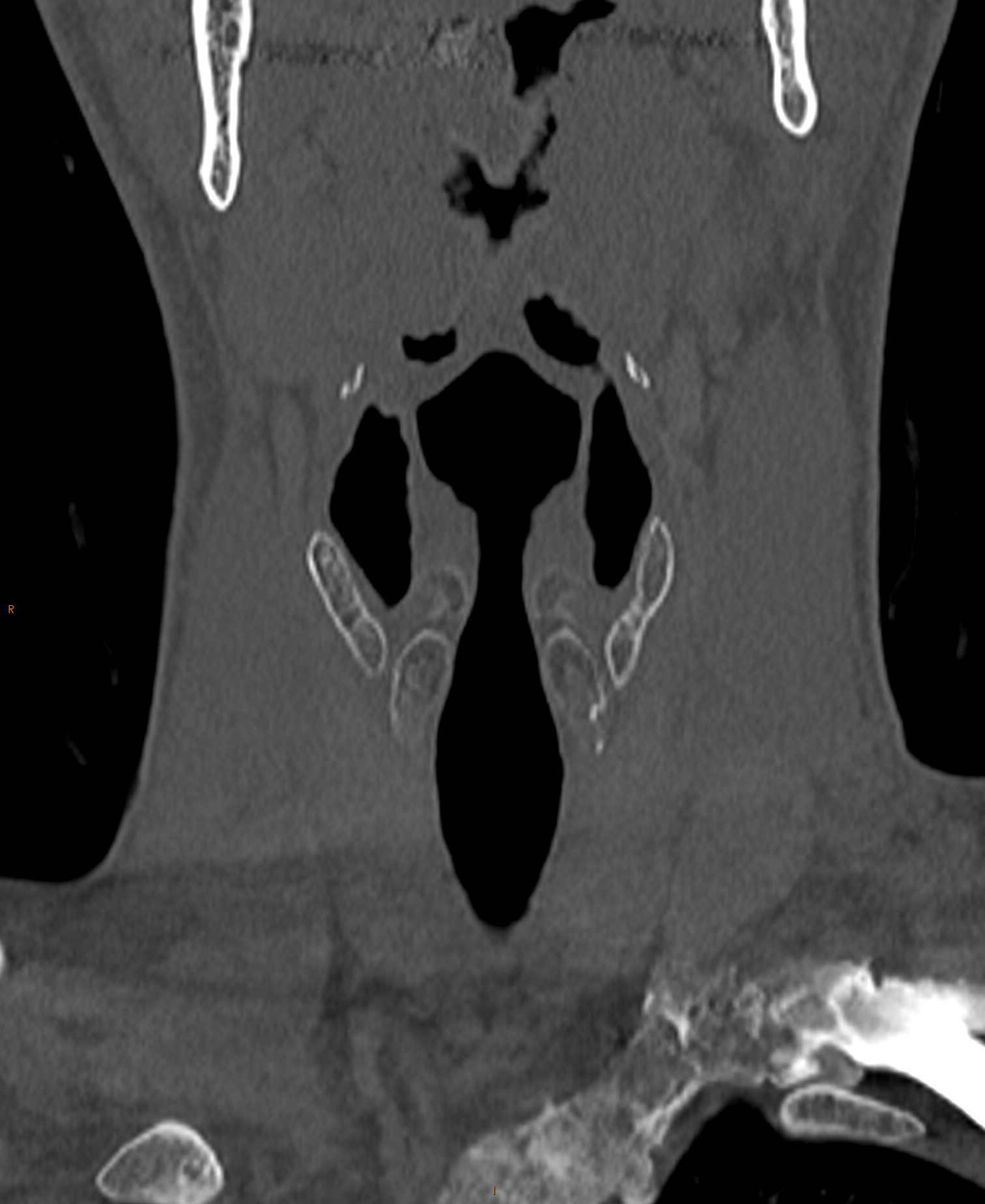 Normal neck (CT) Image
