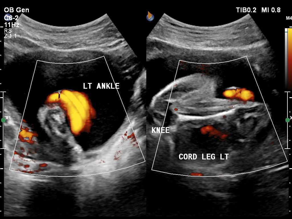 Umbilical cord entanglement Image