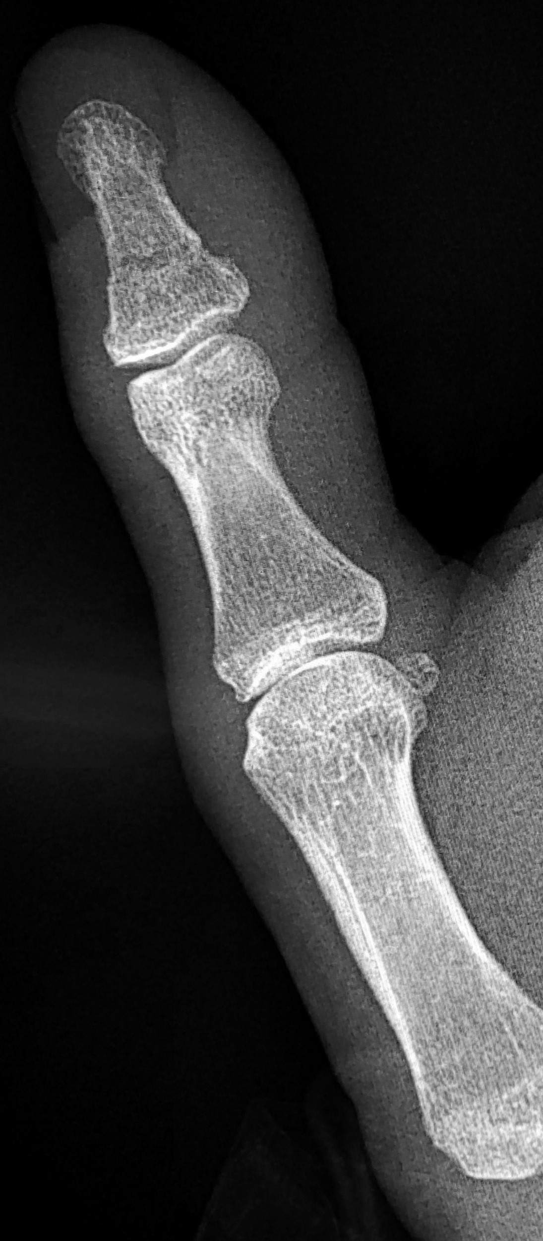 Fracture distal phalanx of thumb Image