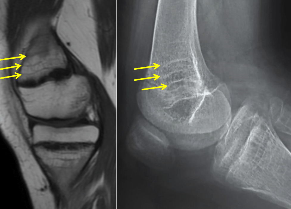 Growth arrest lines and physeal stress injury Image