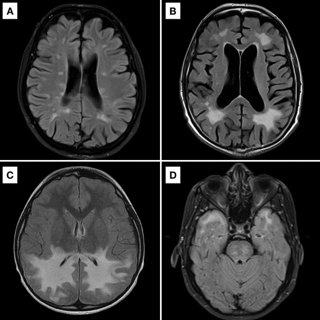 Chronic Microvascular Ischemic Disease slidedocnow
