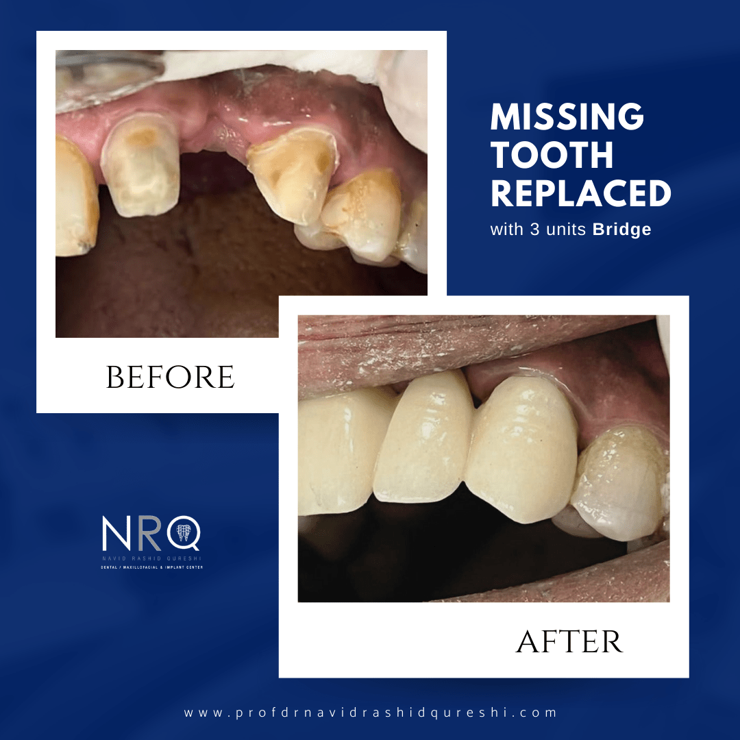 Missing Tooth Replacement with Bridge Best Dentist Doctor in Karachi