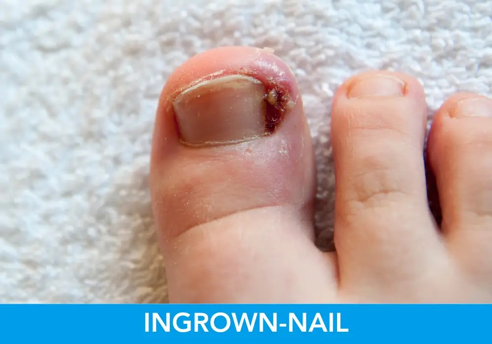 Ingrownnail Profrea