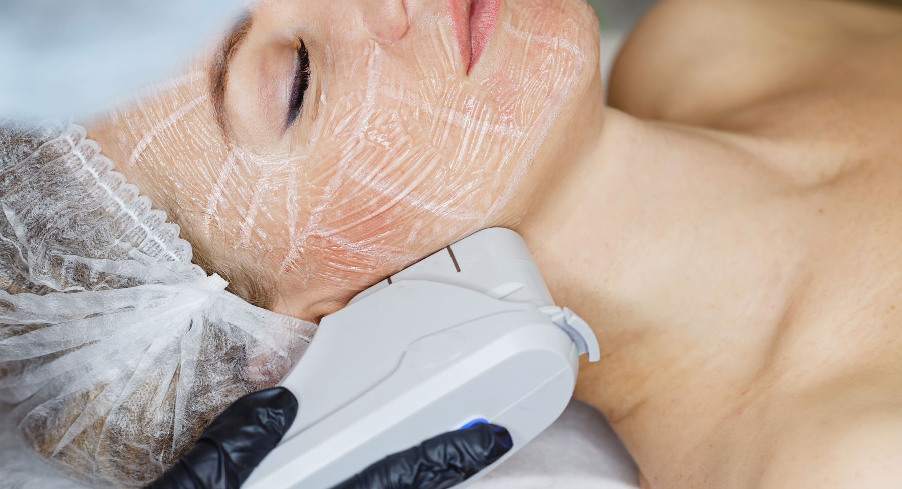 IPL Photofacial as a Way Prevent Skin Cancer Prolase Medispa