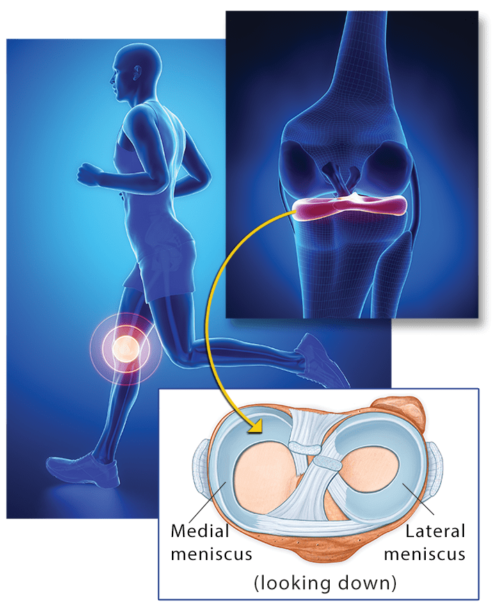 Knee Pain, Meniscal Tears, conditions for prolotherapy Prolotherapy