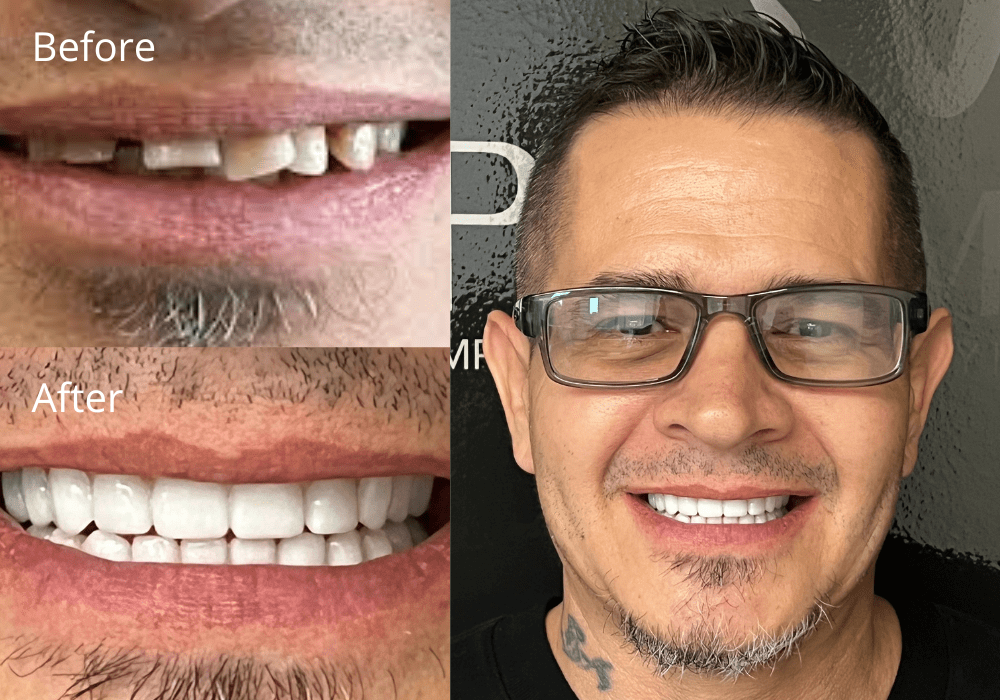 SnapOn Implant Dentures Scottsdale ProSmile Dental Implant Center