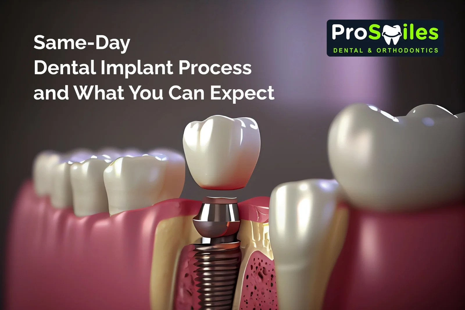 SameDay Dental Implant Process and What You Can Expect — ProSmiles