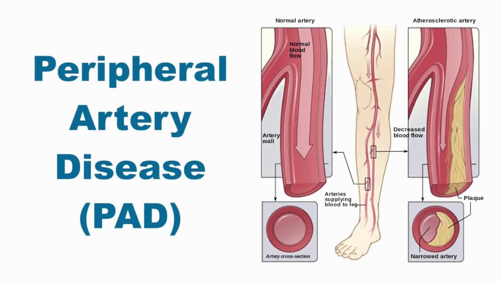 Terapi Sel Punca pada Penyakit Peripheral Arterial Disease