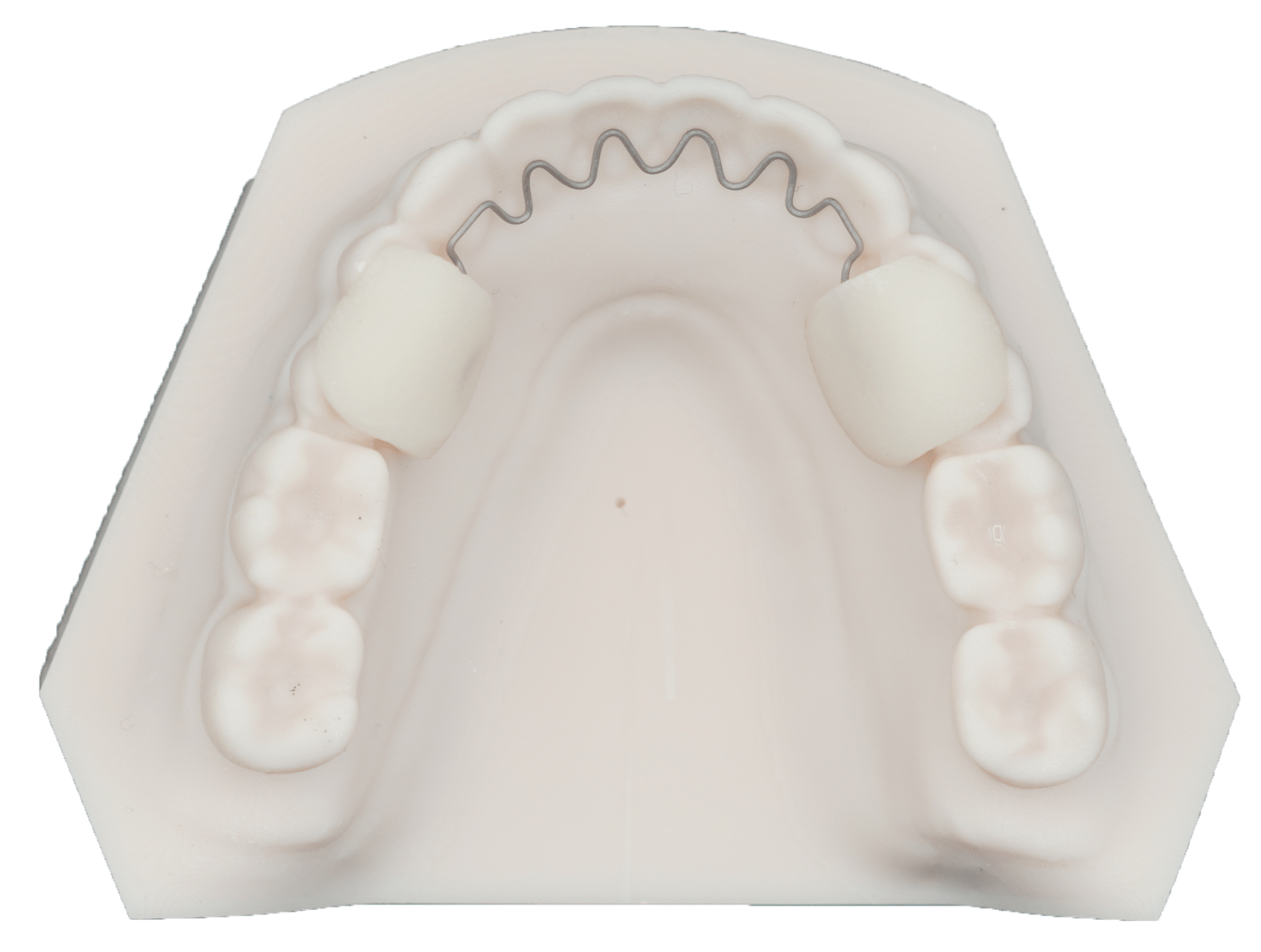 Vloop Bonded Retainer Protec Dental