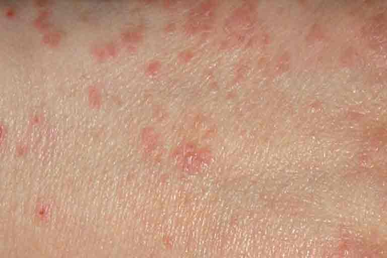 Scabies Communicable Diseases Public & Environmental Health