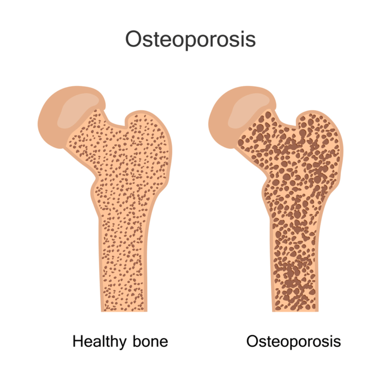 The Benefits of Protein for Osteoporosis Protein Bars