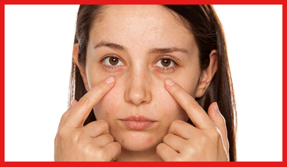 Dark circles remedy চোখের চারপাশে ডার্ক সার্কেল? রইল দূর করার কিছু