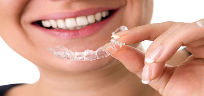 كم مدة مثبت الأسنان بعد التقويم