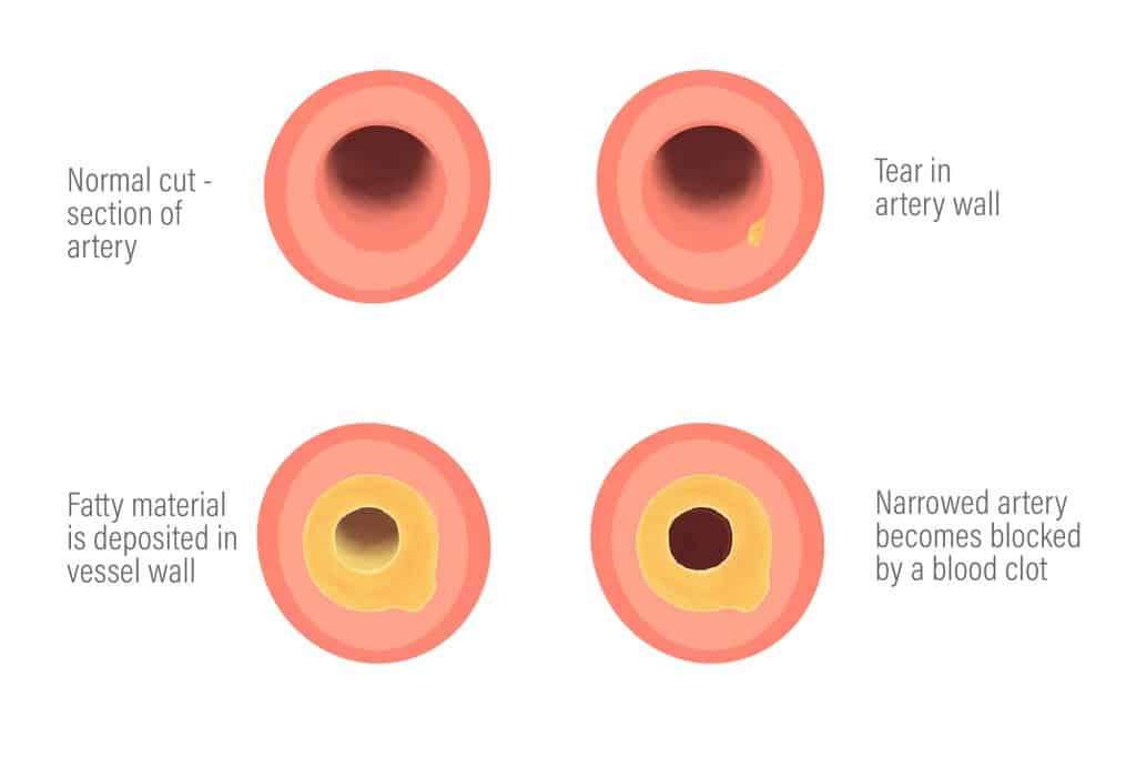 A hearthealthy diet preventing cardiovascular disease ProVeg