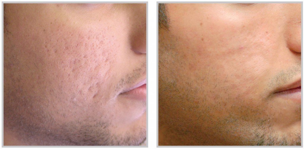 PRP Injection Before & After Platelet Rich Plasma Reviews