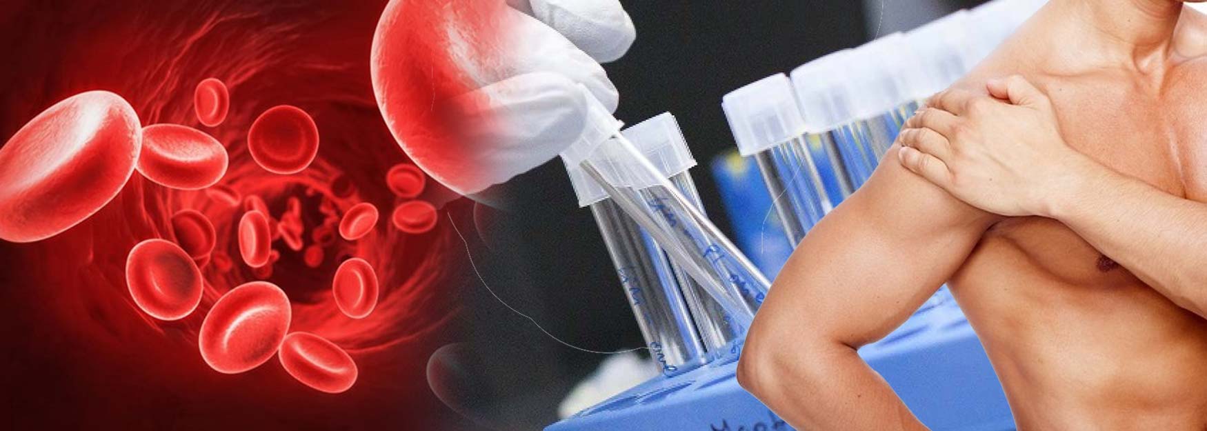 PRP Shoulder Injection PRP for Shoulder Labral Tear