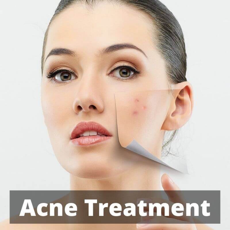 Acne Treatment PRP Treatment center