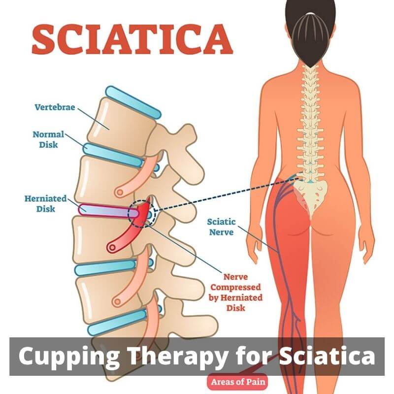 Cupping Therapy for Sciatica PRP Treatment center