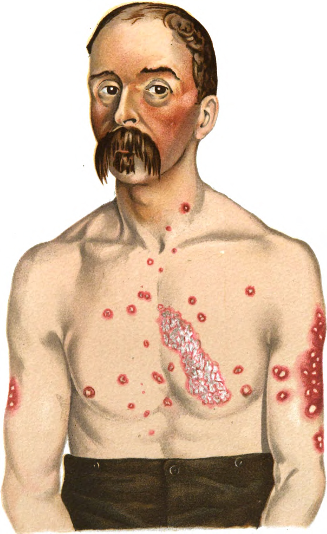 How Psoriasis Vulgaris Is Diagnosed And Treated Psoriasis Help