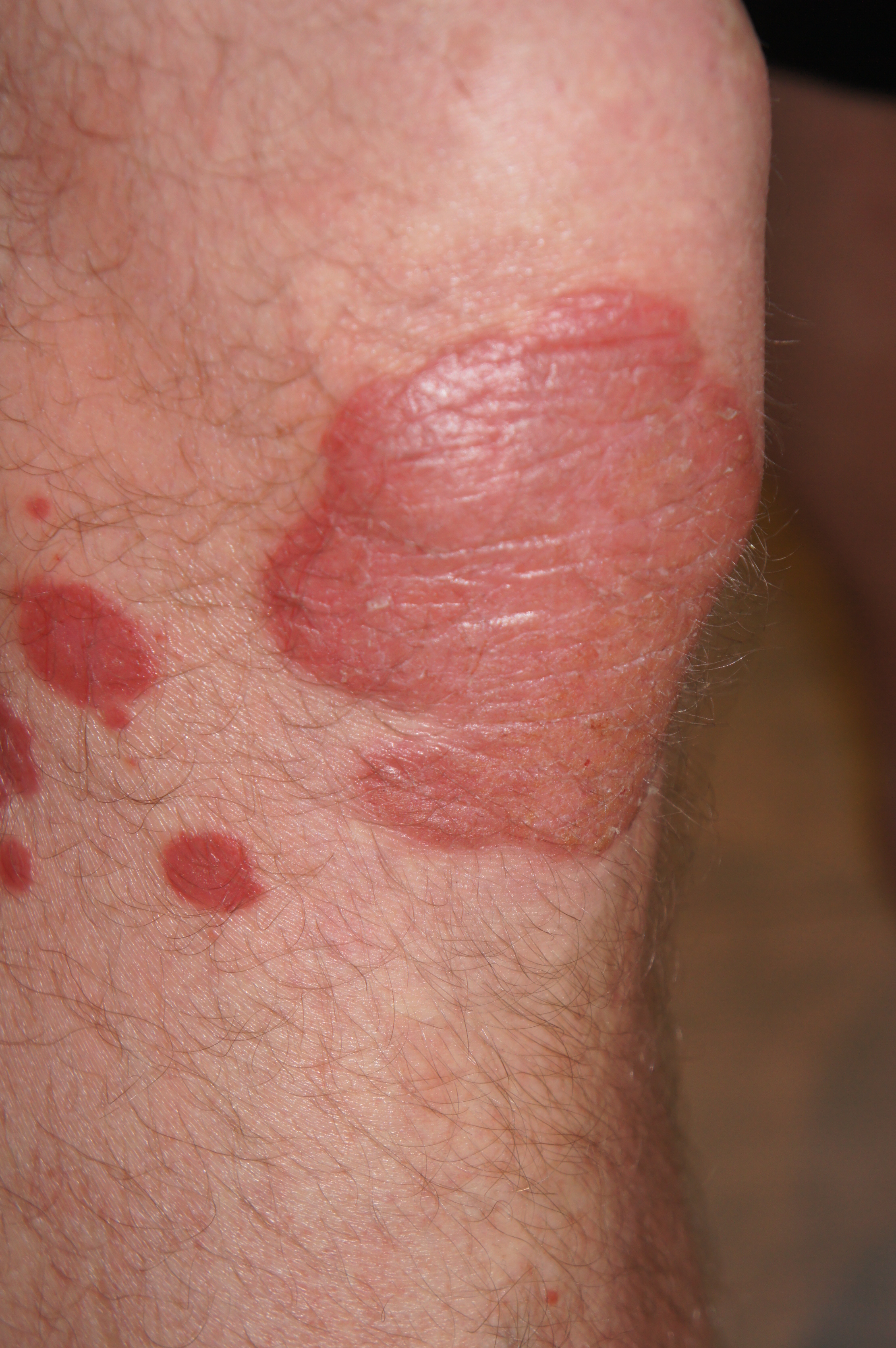 Psoriasis Pictures View Free Images of Psoriasis