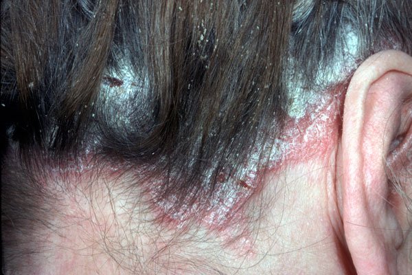 The Top 3 Psoriasis Shampoos The Best OTC Shampoo for Psoriasis