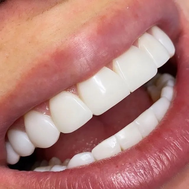 Bonding Prosthodontic Specialists of San Diego Prosthodontist San