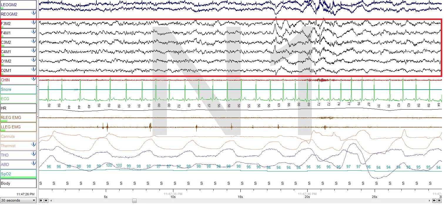 Nonrapid Eye Movement Sleep Psynso