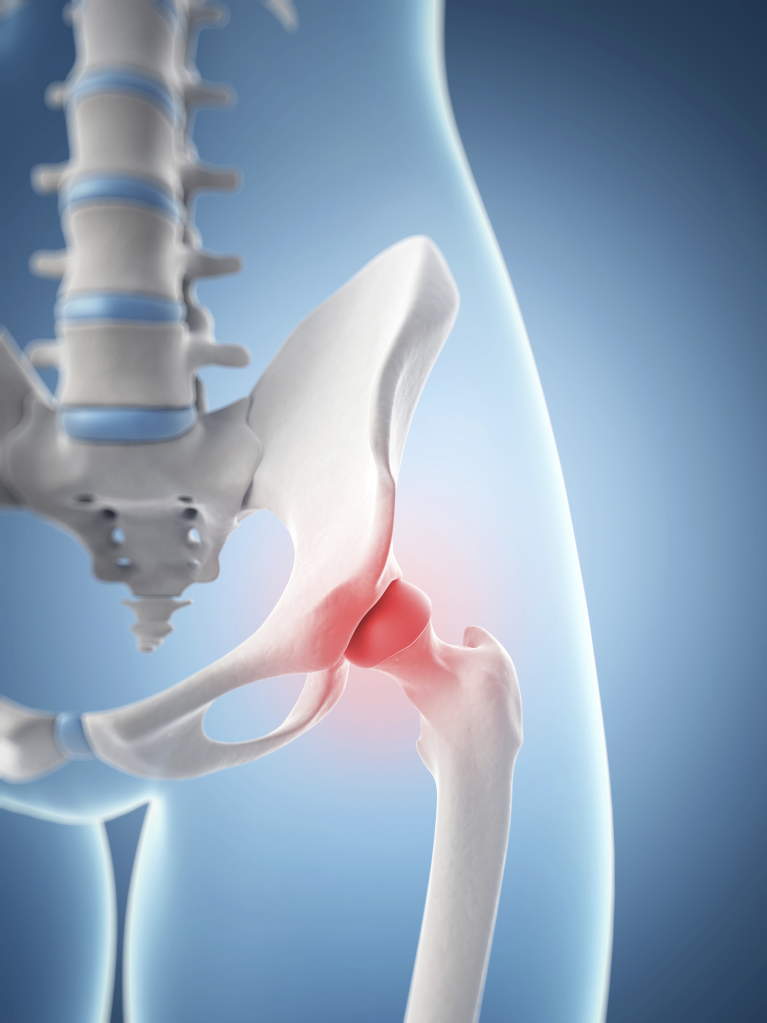 Greater Trochanteric Bursitis PT & ME