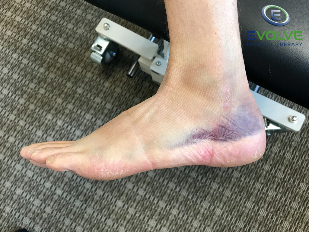 3 Things Tennis Players Can Do For Ankle Sprains And Chronic Ankle Instability [WITH VIDEO] PT