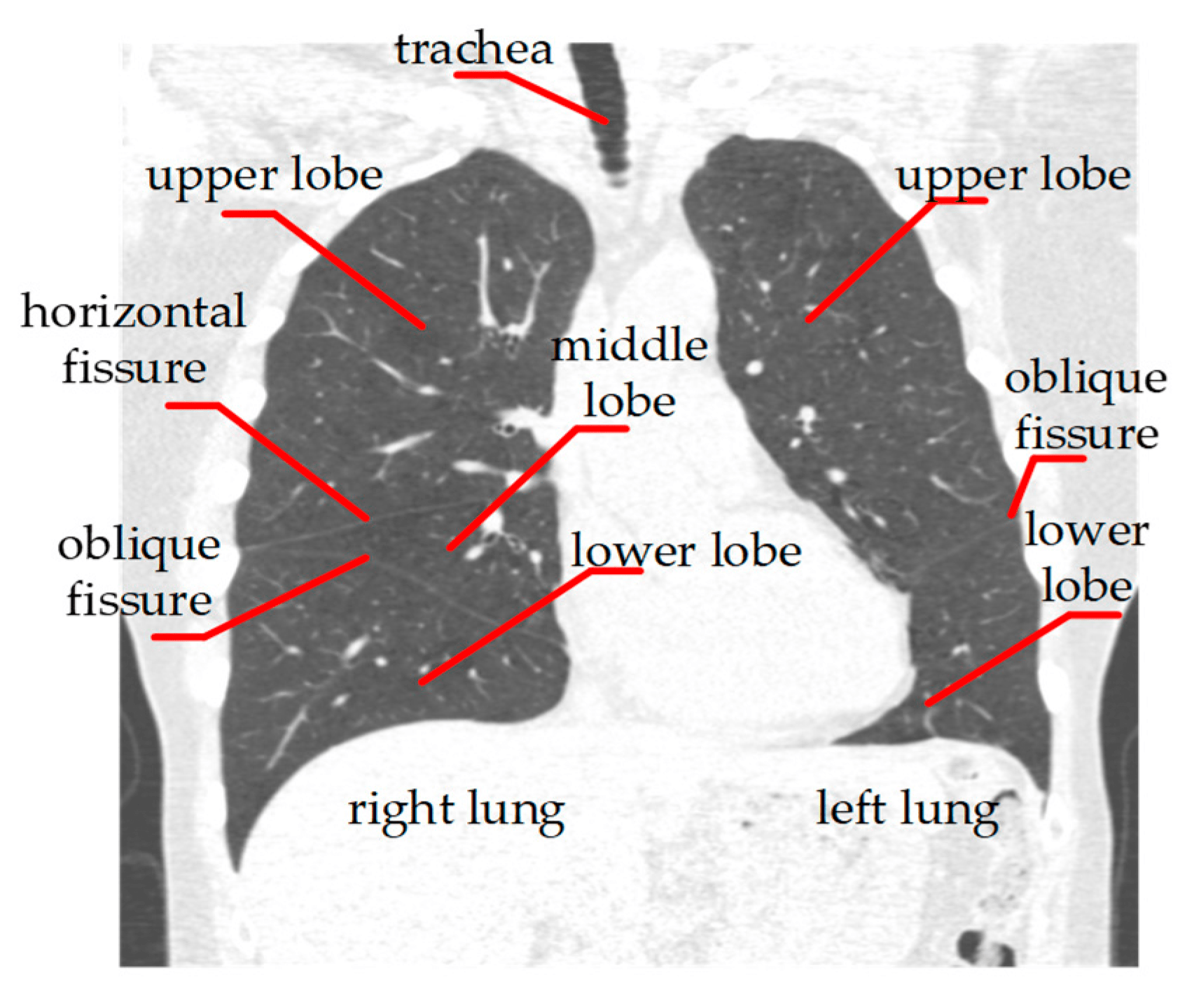 Algorithms Free FullText Lung Lobe Segmentation Based on Lung