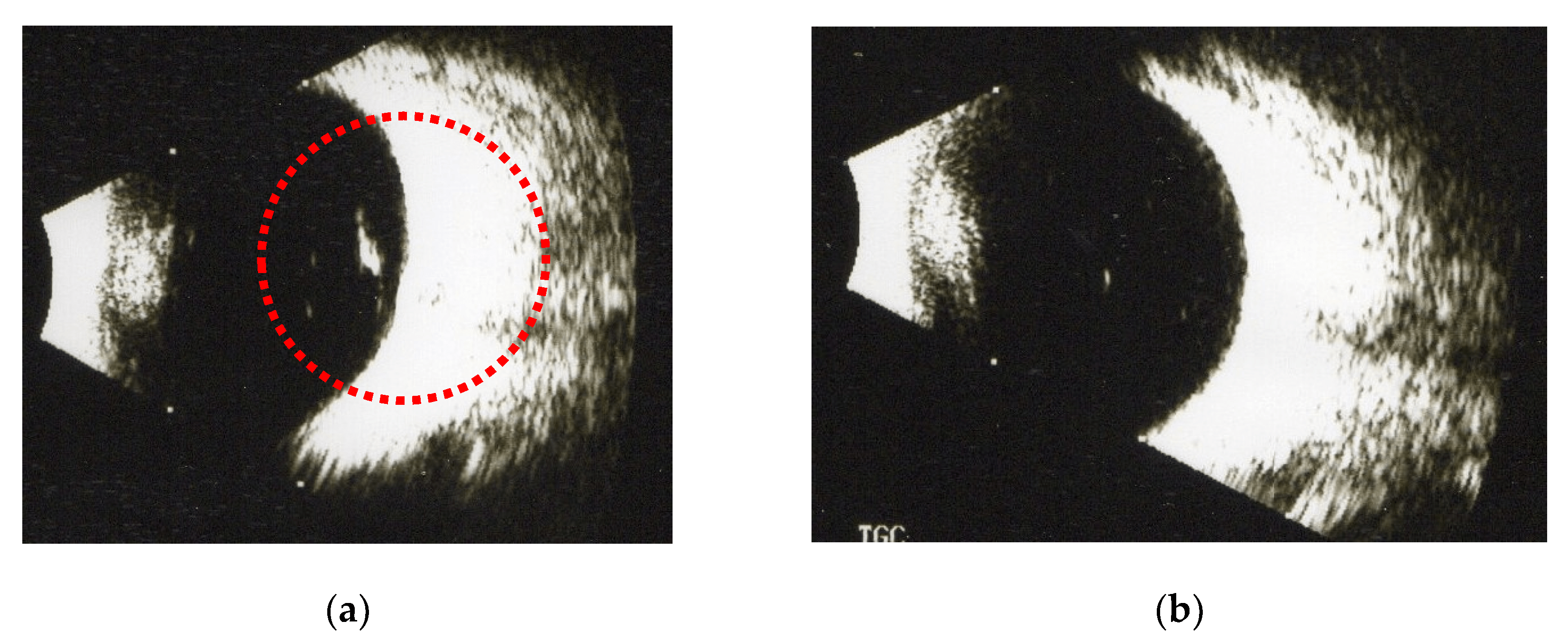 Applied Sciences Free FullText Treatment of Symptomatic Vitreous Opacities with