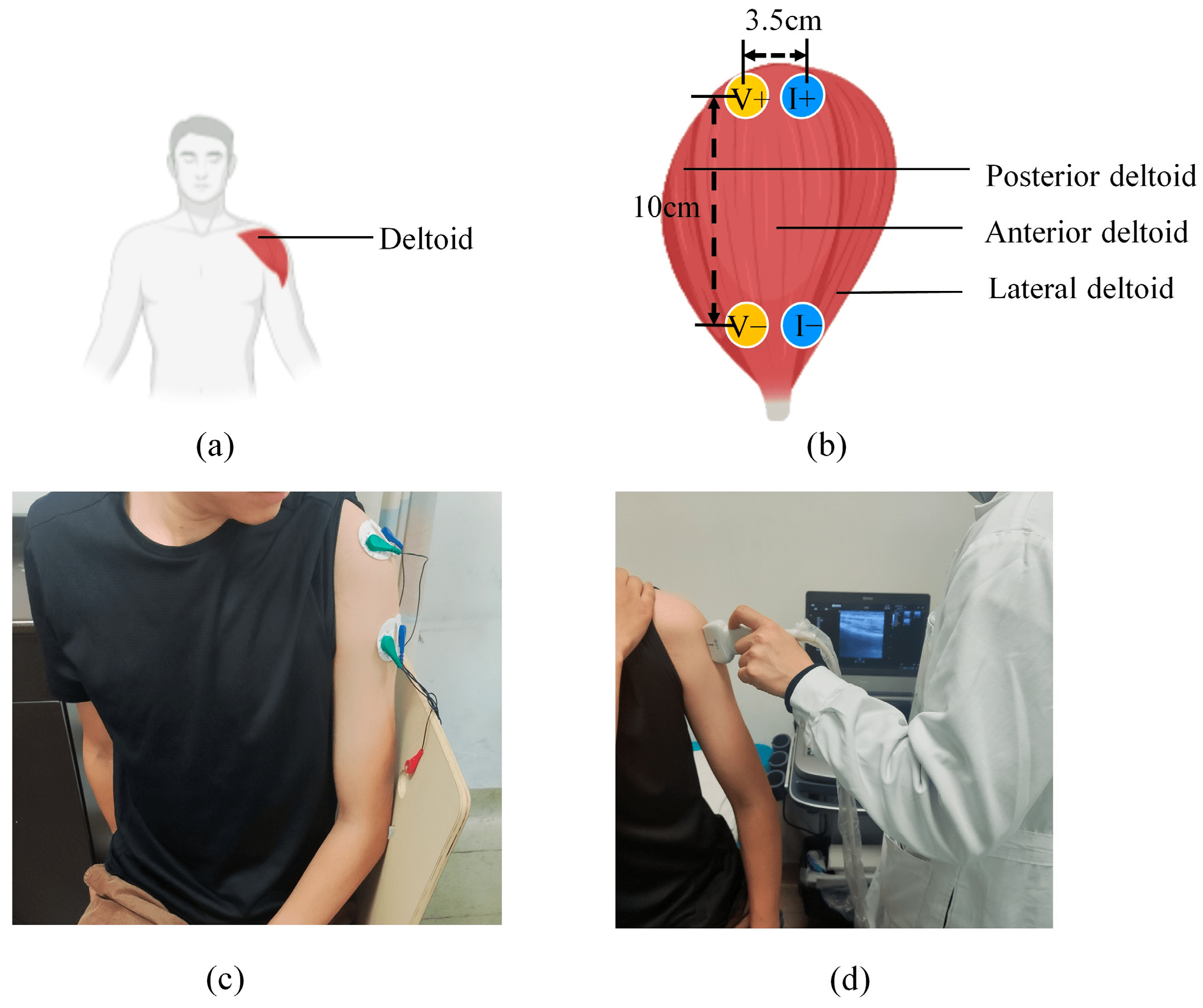 A Wearable Solution of Muscle Atrophy Assessment Oriented Toward Upper