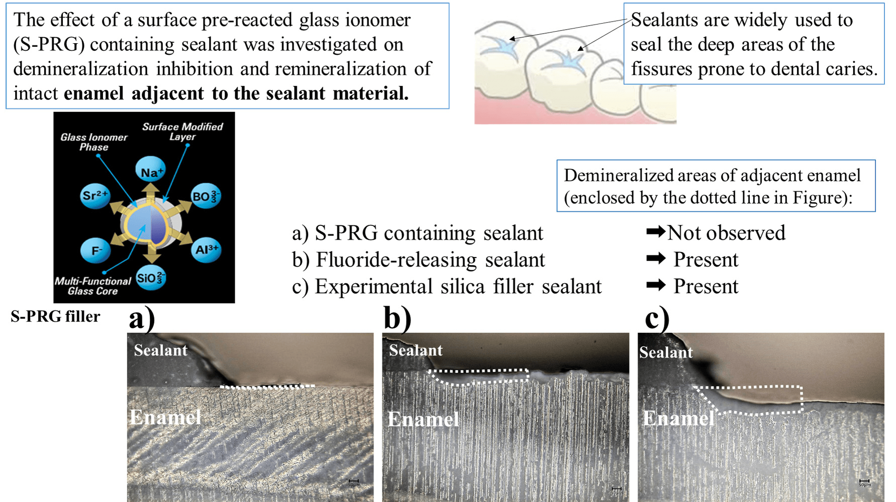 JFB Free FullText Effect of Surface PreReacted Glass Ionomer