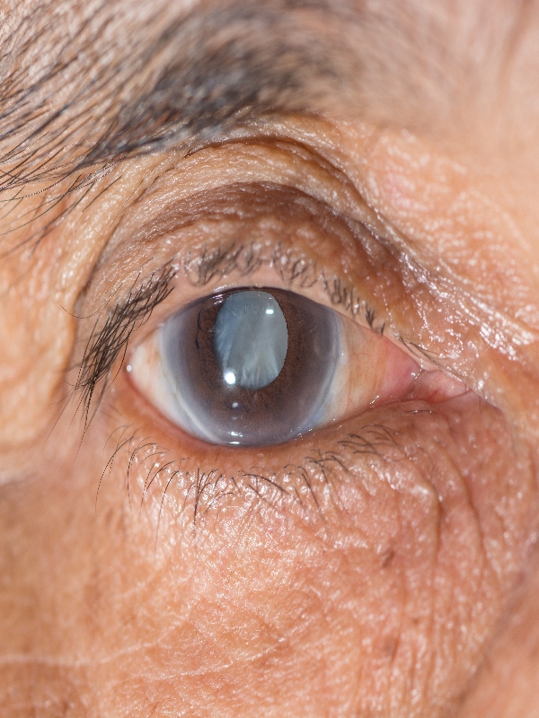 Cataract Treatment MIMS Singapore