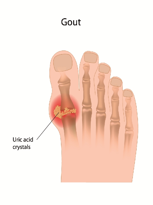 Gout Treatment MIMS Singapore