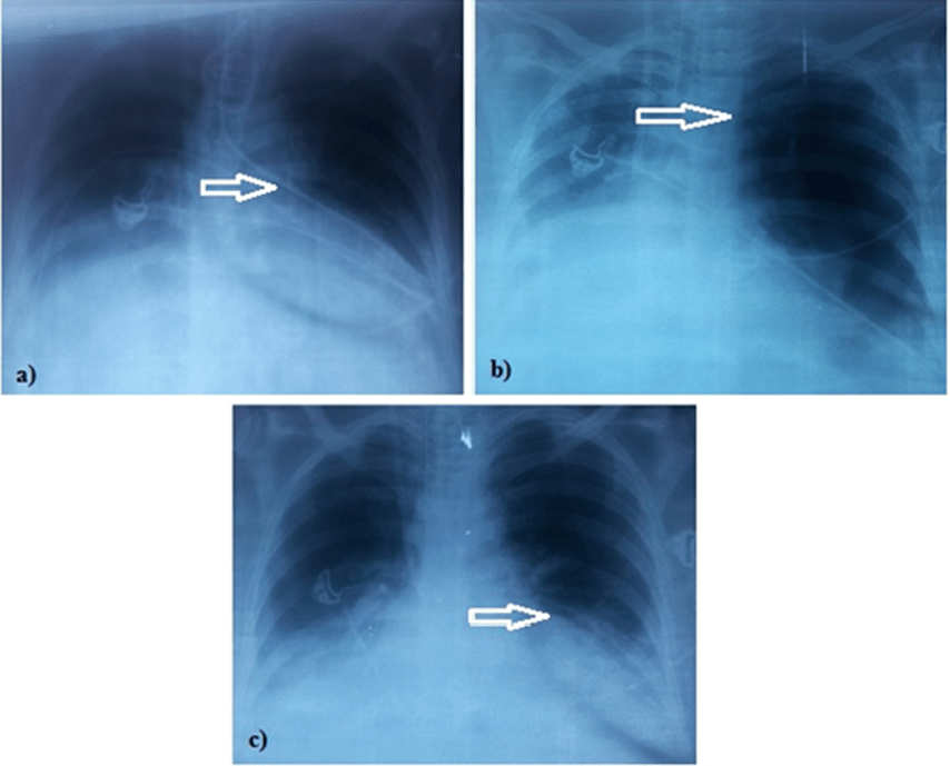 Figure 2. a) Feeding tube incorrectly placed in the left lung. b