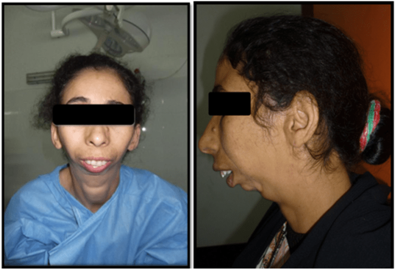 Figure 3. Bird face deformity in bilateral TMJ ankylosis