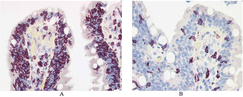Refractory Celiac Disease New Diagnostic Approaches and Current Treatment