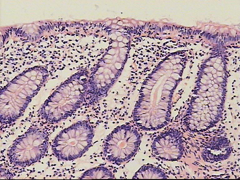 Collagenous Colitis GlutenFree Diet And Weight dubaiinter
