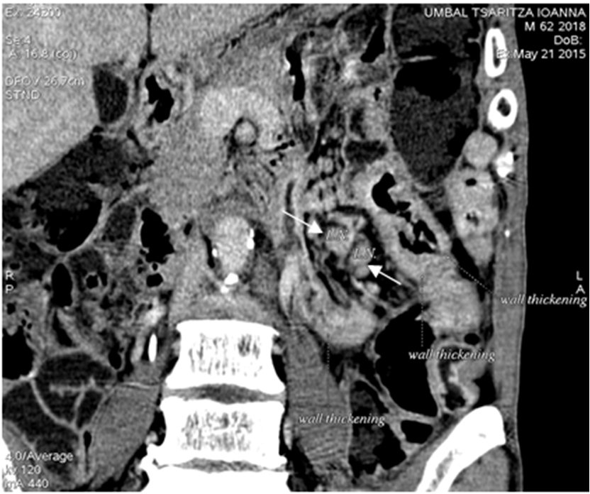 Figure 3. CT enterography Two enlarged mesenteric lymph nodes (white