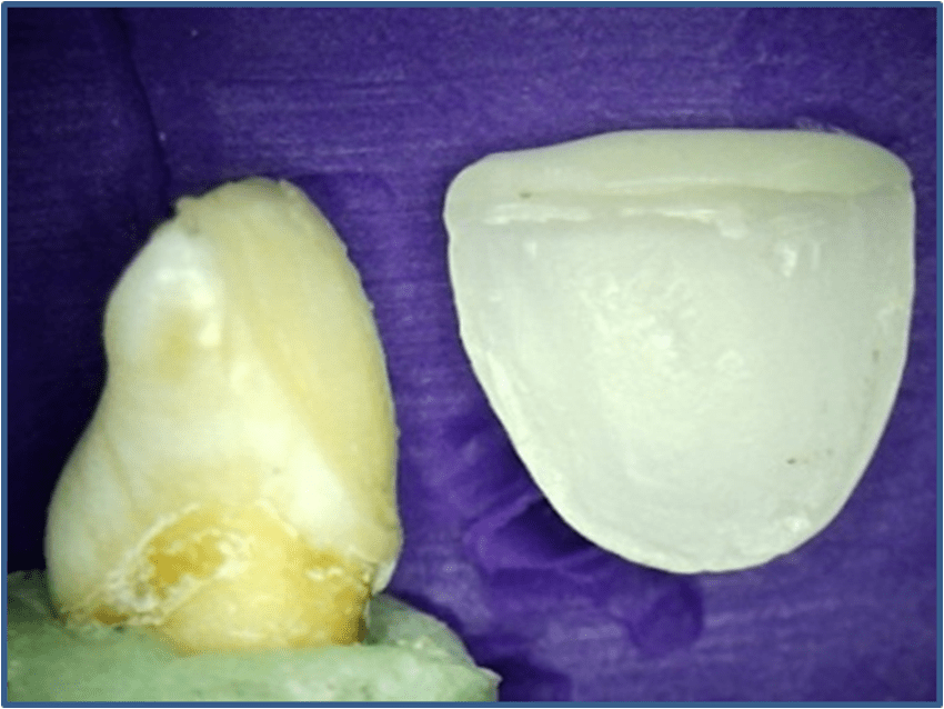 Figure 2. Debonded laminate veneer sample Effect of Ultrasonic