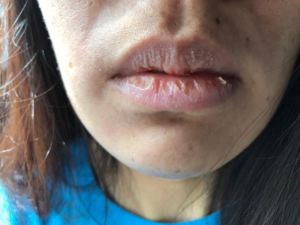 Why won't my lips stop peeling? PUCHONGIAN 蒲种人