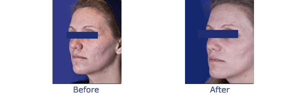 Fractional CO2 Laser Pictures Puffy Eyes New York Cosmetic Surgery