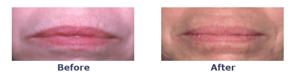 Laser Skin Resurfacing Pictures Puffy Eyes New York Cosmetic Surgery