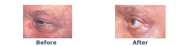 Laser Skin Resurfacing Pictures Puffy Eyes New York Cosmetic Surgery